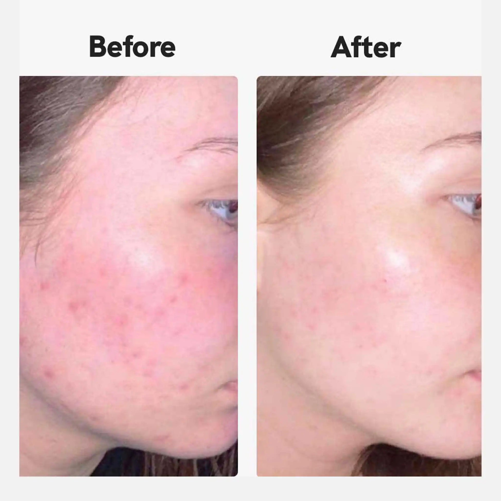 Før og efter billede af en kunde, der bruger acnecreme fra NordicOil