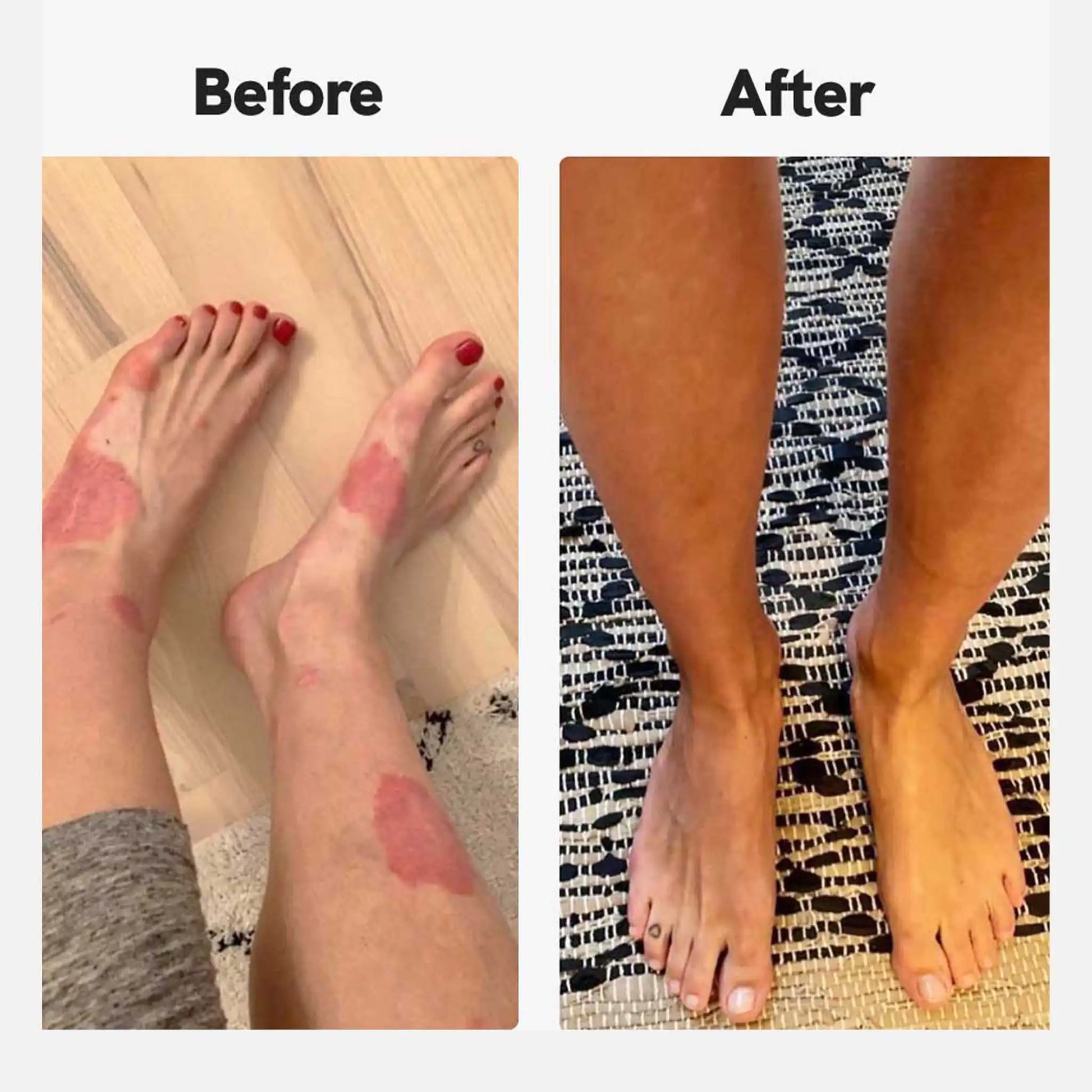 Før og efter billede af en kunde, der bruger Psoriasis Cream fra NordicOil